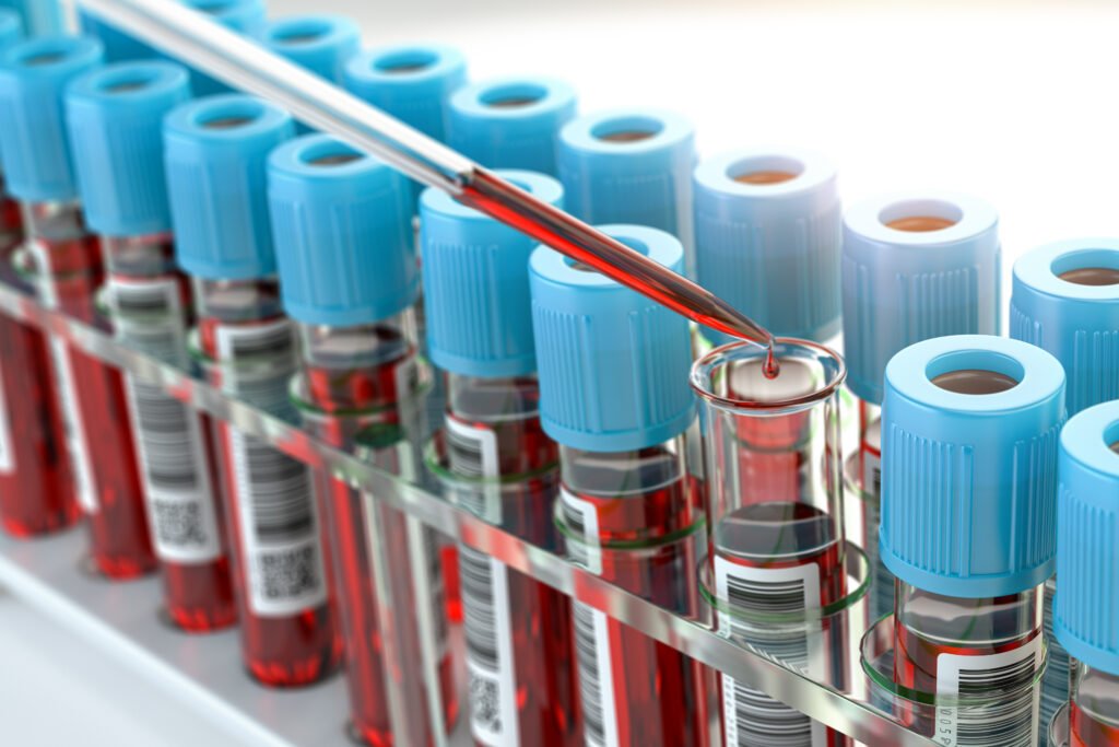 Pipette transferring a blood sample into a tube, illustrating laboratory testing for Alzheimer’s biomarkers.